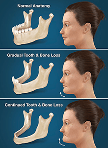 Full Arch Dental Implants West Hollywood