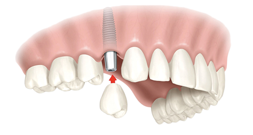 Single Dental Implants West Hollywood