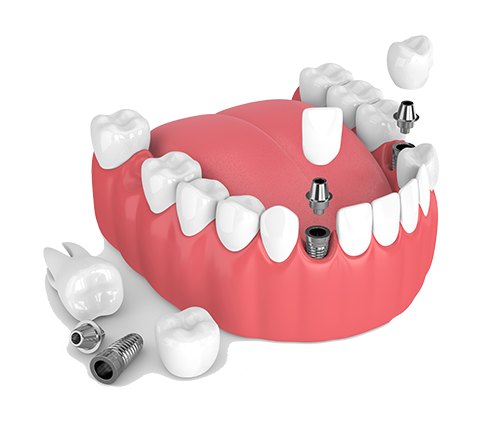 Multiple Teeth Dental Implants in Texas
