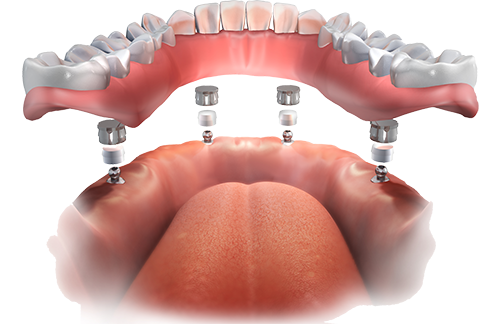 Implant Overdentures West Hollywood